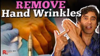 HAND FILLER  How to Remove Hand Wrinkles [upl. by Pallua976]