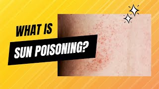 What is sun poisoning [upl. by Rhyne]