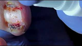 DIY Ingrown Toenail Removal  How to Safely Cut Ingrown Toenails at Home [upl. by Alonzo322]