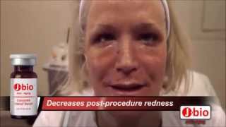 CO2 Laser Skin Tightening PostProcedure Treatment [upl. by Lipman]