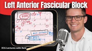 Left Anterior Fascicular Block LAFB EKG  ECG Lecture [upl. by Kiki]