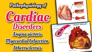 Pathophysiology of Cardiac disorders  Angina pectoris amp its types  Myocardial infarction amp Causes [upl. by Kerrill383]