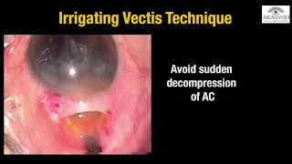 Episode 5  Nucleus delivery and Cortex aspiration in MSICS [upl. by Oicul]