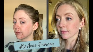 ACNE JOURNEY  MY Side Effects on Spironolactone and Doxycycline [upl. by Cirdes712]