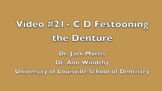 Video 21 C D Festooning the denture  Demonstration [upl. by Noelani127]