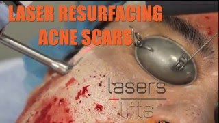 LASER RESURFACING ACNE SCARS with 2 lasers in the one session [upl. by Harraf]