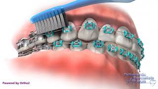 Proper Brushing  Orthodontic Care Instructions [upl. by Issim409]