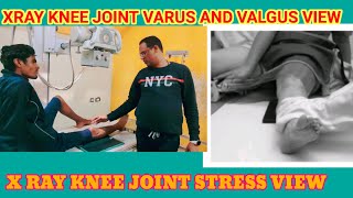 X RAY KNEE JOINT STRESS VIEW VALGUS AND VARUS PROJECTION [upl. by Doro]