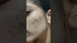 use tretinoin 0025 before and after result face acne darkspots pimpleproblem tretinoin dark [upl. by Charmane838]