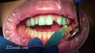 porcelain dental veneer bridge and veneers cosmetic dentistry before and after [upl. by Nemzaj]