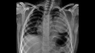 TMT LUNG OPACITY 10 YR OLD CHILD [upl. by Anana]