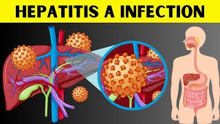 Hepatitis A Infection  Signs amp Symptoms Risk Factors Virology Diagnosis And Treatment [upl. by Nigem]