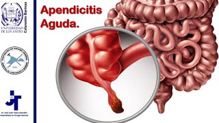 Apendicitis Aguda [upl. by Ael]