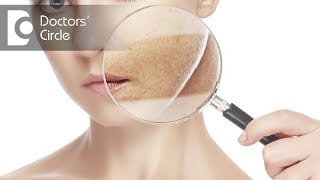 Natural ways to manage pigmentation due to hormonal imbalance in girls  Dr Rashmi Ravindra [upl. by Adnohral]