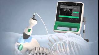 Verathon BladderScan Prime Portable Ultrasound Instrument [upl. by Enoj]