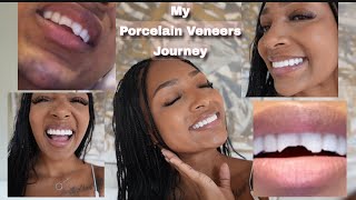 I Got Veneers in Beverly Hills by Dr Joshua Ghiam [upl. by Yrome666]