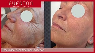 Fractional Laser Treatment for Face Non Ablative Rejuvenation Eufoton [upl. by Dimitry]