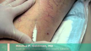 Sclerotherapy For Leg Veins  Mitchel P Goldman MD  San Diego [upl. by Neelhtac765]