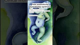 Fetal postmaturity dysmaturity syndrome [upl. by Rosita]