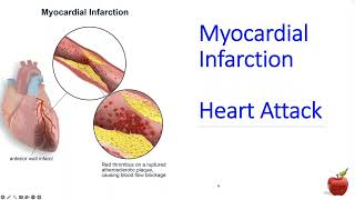 ICD 10 CM coding for a Heart Attack STEMI vs NSTEMI for Beginners [upl. by Cutler]