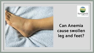 Can Anemia cause swollen leg and feet  Dr Maran on pitting pedal edema [upl. by Hyatt]