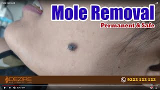 Mole Removal in Delhi  Face Mole Removal Treatments  How to Remove Moles   Live  Dezire Clinic [upl. by Mcnair684]