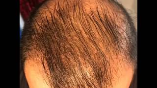 14 month’s using minoxidil  Rogaine 5 Before amp After results [upl. by Cleon]