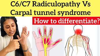 C6C7 Radiculopathy Vs Carpal tunnel syndrome carpaltunnelsyndrome cervicalpain radiculopathy [upl. by Hays]