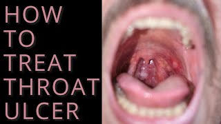 How to treat throat ulcer [upl. by Wagoner]