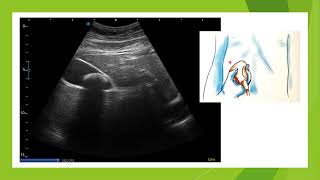 Lithiase vésiculaire en échographie pièges et astuces [upl. by Katusha]