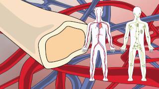 Video 20 Waldenstroms Macroglobulinemia [upl. by Herrle]