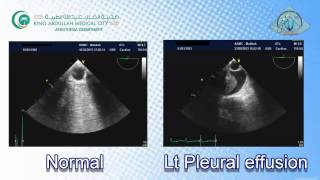 060 Pleural Effusion TEE KAMC [upl. by Ihsoyim]