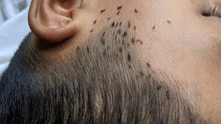 How to get rid hundred lice from short hair  Remove all big lice from black hair [upl. by Ranitta]