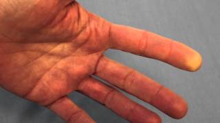 Raynauds Phenomenon Reduced Blood Flow of the FIngertip [upl. by Adianes32]