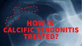 How is calcific tendonitis treated [upl. by Marbut]