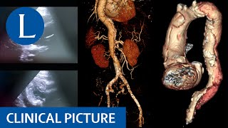 Leg weakness and paraesthesia provides a clue to sudden death [upl. by Sinnod]