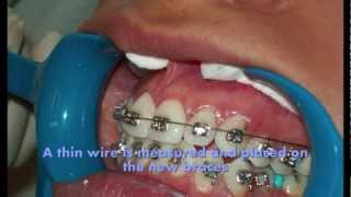 How braces are put on teeth 2012 [upl. by Pepe116]