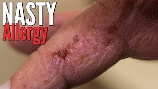 Nasty Skin Reaction From Sawdust  Contact Dermatitis [upl. by Nomrac938]