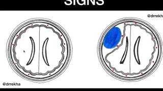 Extra axial lesion  Easy Signs to identify [upl. by Enoyrt558]