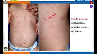 Common viral infection  Roseola Infantum Erythema Infectiosum Chickenpox Herpes Zoster S8 Pede [upl. by Ledba]