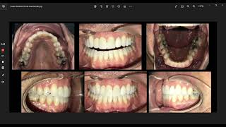 Adult Unilateral Posterior Crossbite  Clearly Aligners [upl. by Ten]