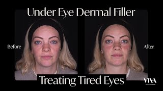 Under Eye Filler Before and After 😴 2021 [upl. by Annawt]