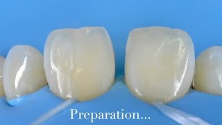 Diastema Closure by resin composite  free hand technique [upl. by Trammel]