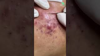 Inflamed Acne and Blackhead Removal CloseUp Secrets to Clear and Smooth Skin [upl. by Millian]