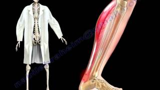 Achilles Tendon Stress amp Strain  Everything You Need To Know  Dr Nabil Ebraheim [upl. by Hsepid]