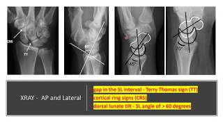 Anatomy of Scapholunate Ligament of the wrist [upl. by Hild921]