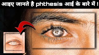 क्या आप जानते है Phthisis eye के बारे में  phthisis eye in Hindiphthisis eye  phthisis bulbi eye [upl. by Redd]