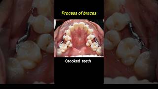 Crooked teeth braces process braces orthodontist dentist crookedteeth [upl. by Jackelyn]