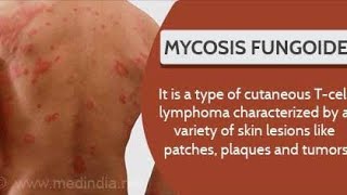 Mycosis Fungoides  Cutaneous T cell Lymphoma  Causes Diagnosis and Treatment [upl. by Cissy]