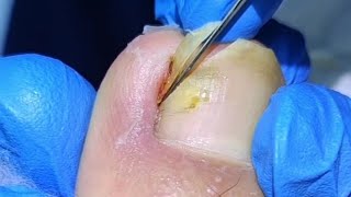 Removing Infected Ingrown Toenail by Professional [upl. by Tnomad]